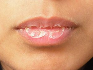 Симптомы псориаза на губах