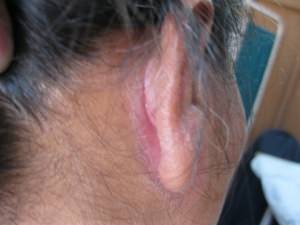 Симптомы псориаза на ушах