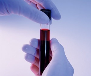 Анализы крови при псориазе