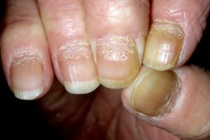 Как выглядит псориаз ногтей