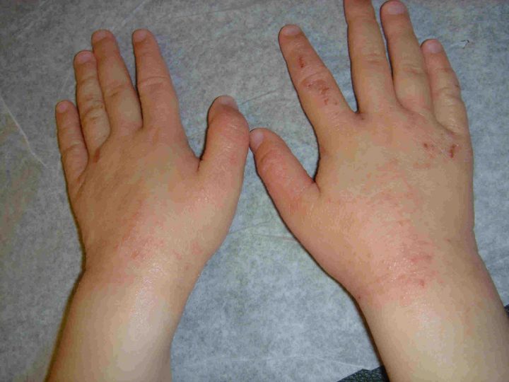 Симптомы псориаза на руках