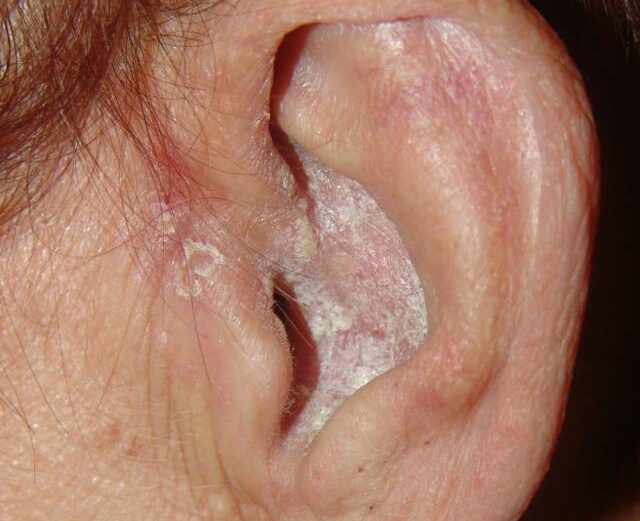 Болезнь на ушах